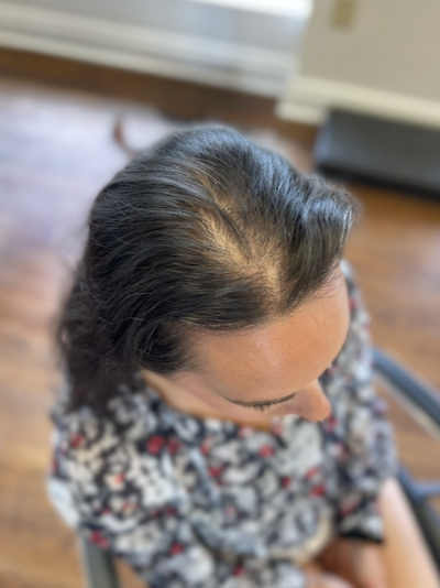 Hair loss solutions Woodstock